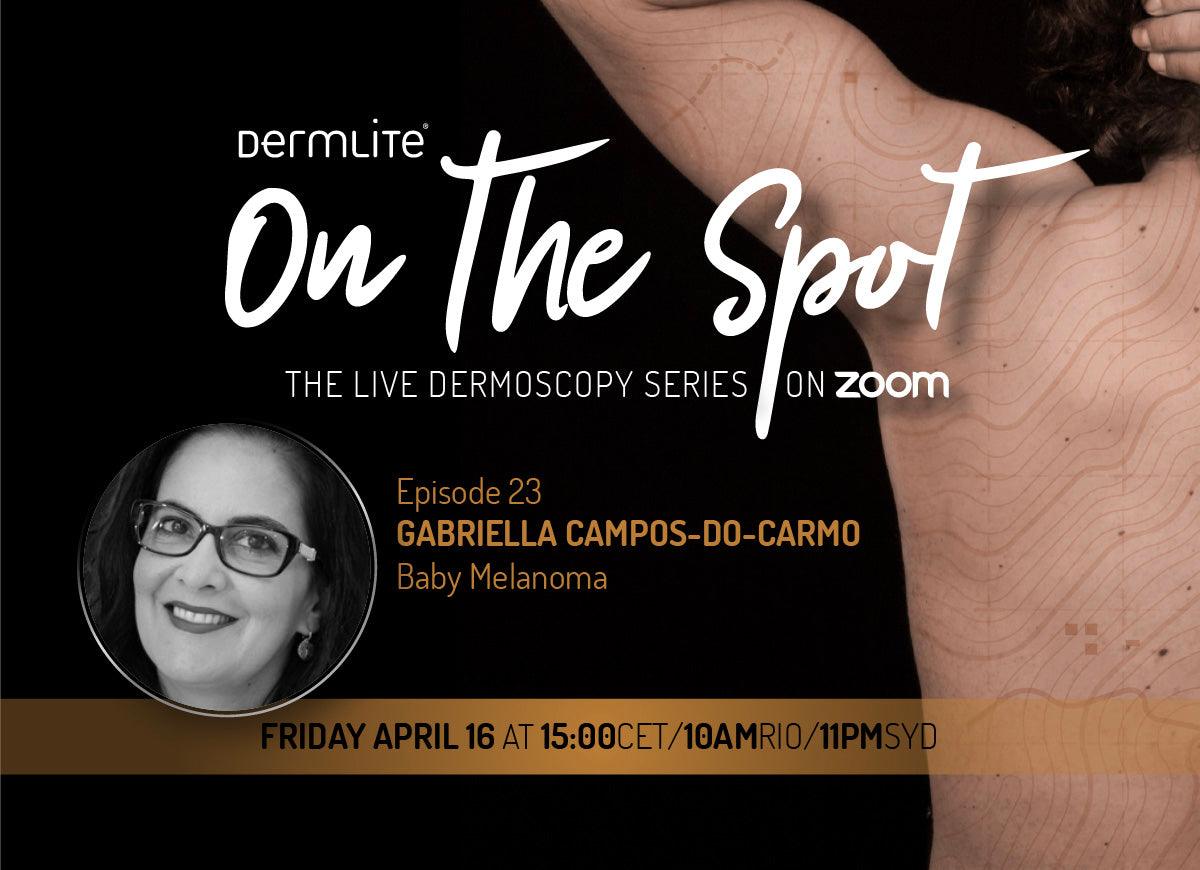 E23 | Baby Melanomas - DermLite