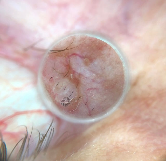 DL5 Small Contact Plate - DermLite